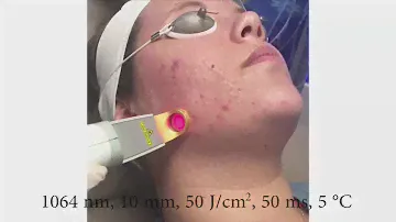 Cutera Excel V Acne Treatment - Effectively Remove Acne & Acne Scarring!